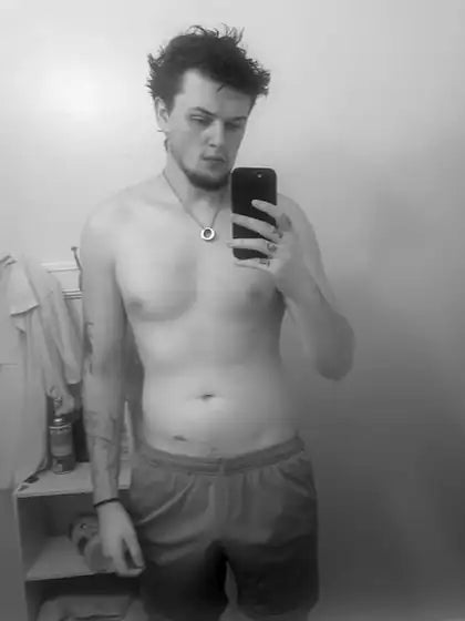 Me after surgery, around 170 lb